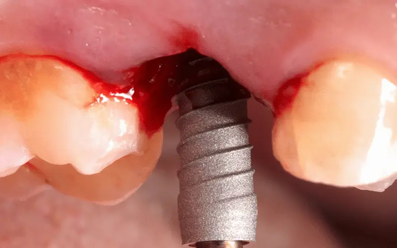 cursos de implantología y cirugía oral