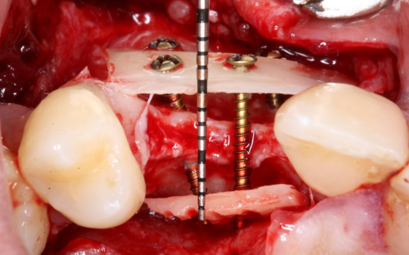 Colocación de Implante Dental - Procedimiento Quirúrgico